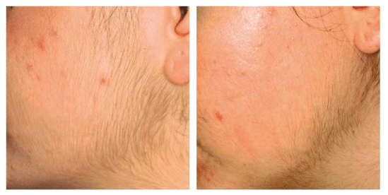 Understanding IPL Hair Removal Permanence and Results